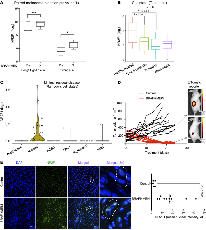 NR2F1 is highly expressed in melanoma lesions of patients on BRAFi + MEK...