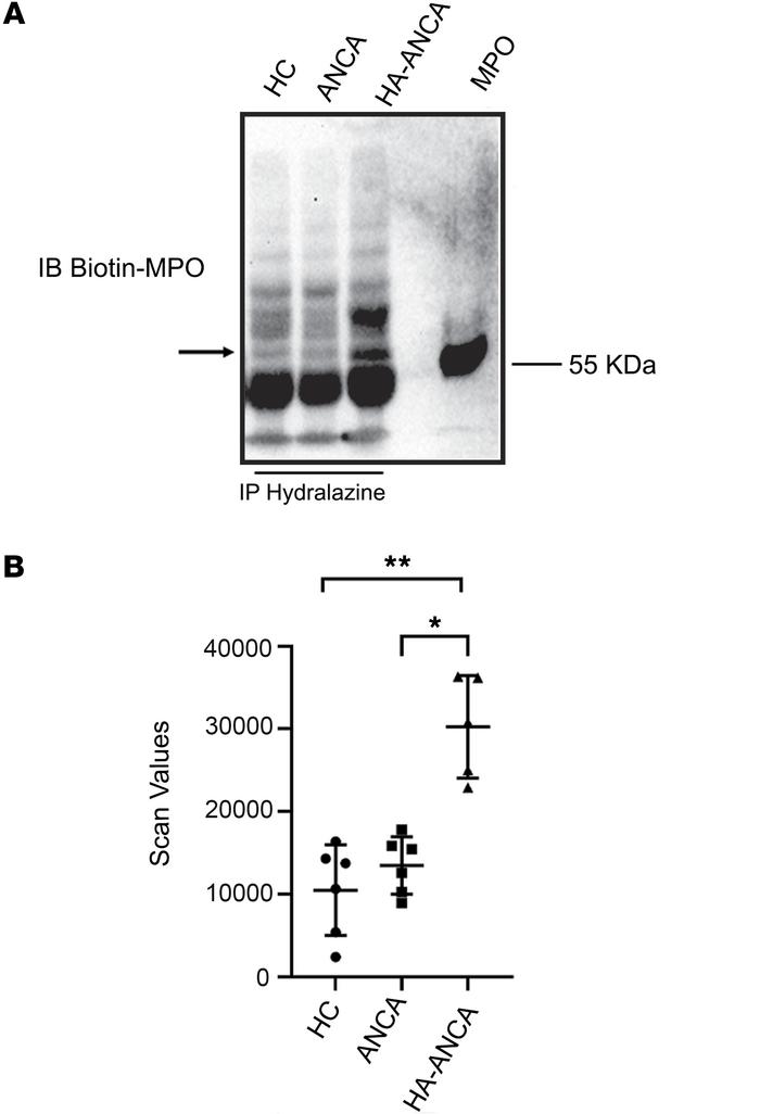 Hydrazone adducts are detected on circulating MPO only from patients wit...