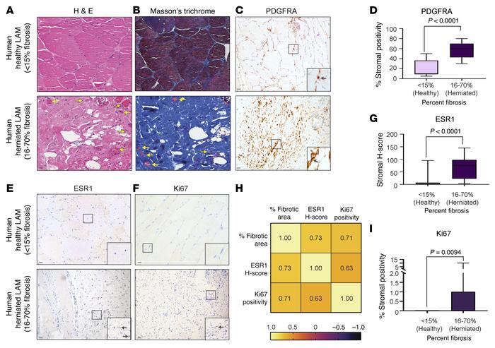 Histopathology of LAM in men with inguinal hernias.
(A–C, E, and F) Repr...
