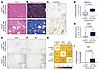 Histopathology of LAM in men with inguinal hernias.