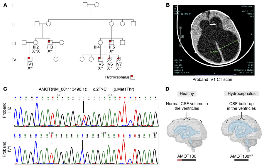 AMOT-linked congenital hydrocephalus presentation in the affected family...