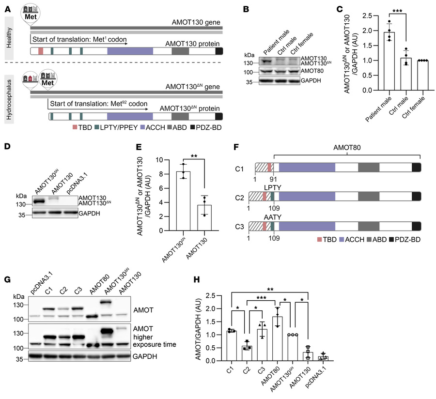 Single point mutation in the start codon of the AMOT gene leads to an in...