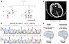 AMOT-linked congenital hydrocephalus presentation in the affected family.