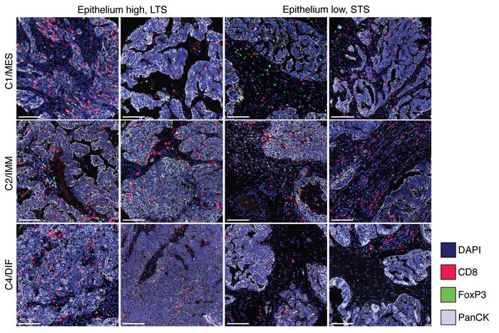 Multiplex IF images showing CD8+ and FoxP3+ TILs in epithelium-high vers...