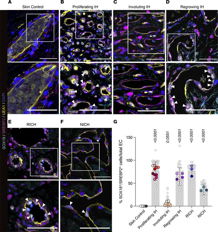 Nuclear colocalization of SOX18 and SREBP2 in IH and congenital vascular...