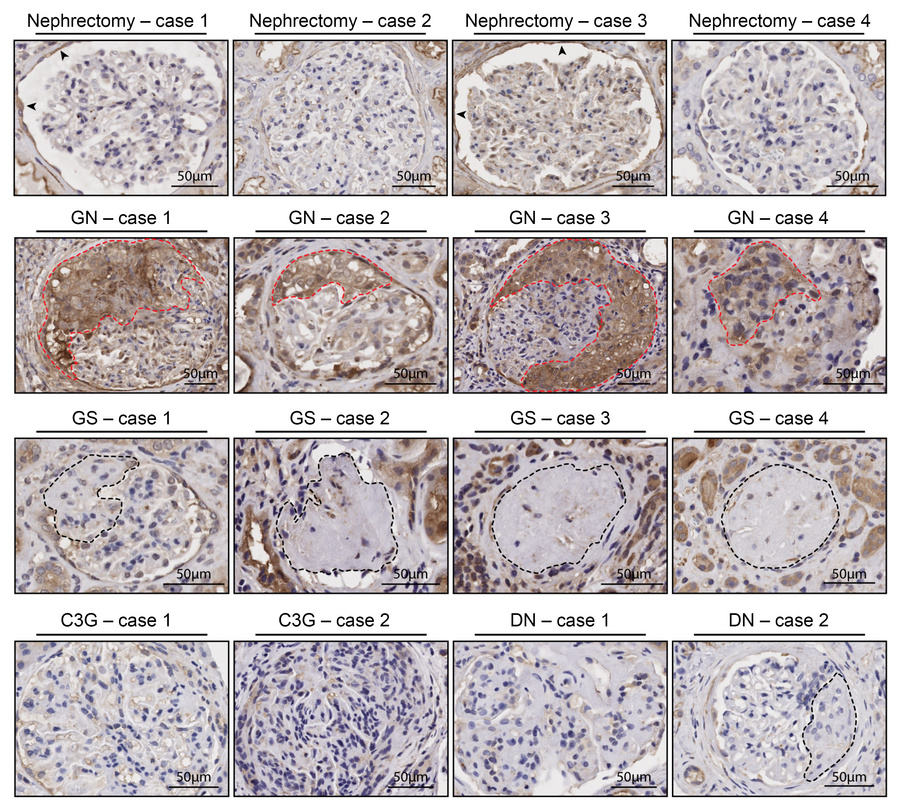 TSP-1 markedly expressed in glomerular crescents of patients with AAV.
R...