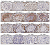 TSP-1 markedly expressed in glomerular crescents of patients with AAV.