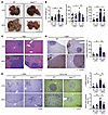 Suppression of metastatic liver tumor growth enhanced by metabolic dysfunct