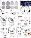 Increased CAF infiltration and immunosuppressive TAM and T cell phenotypes