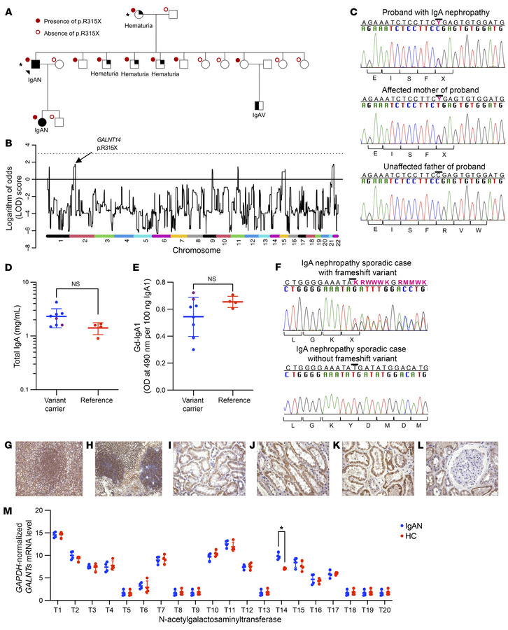 Genetic variation of GALNT14 in familial IgAN and expression in lymphoid...