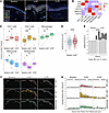 Spatial analysis of cutaneous inflammatory infiltrate on tebentafusp.