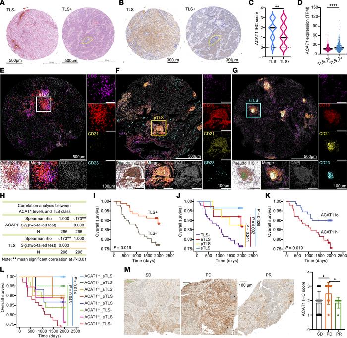 ACAT1 correlates with tertiary lymphoid structure abundance and non–smal...