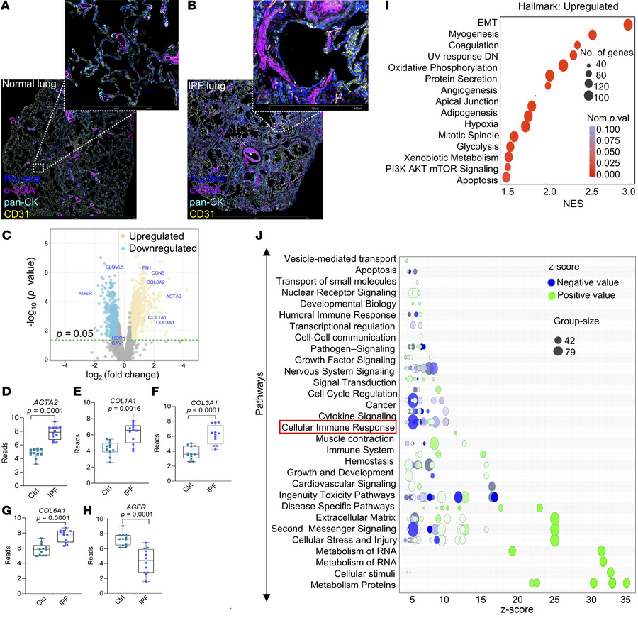 Spatial transcriptomics of IPF fibroblastic foci suggests suppression of...