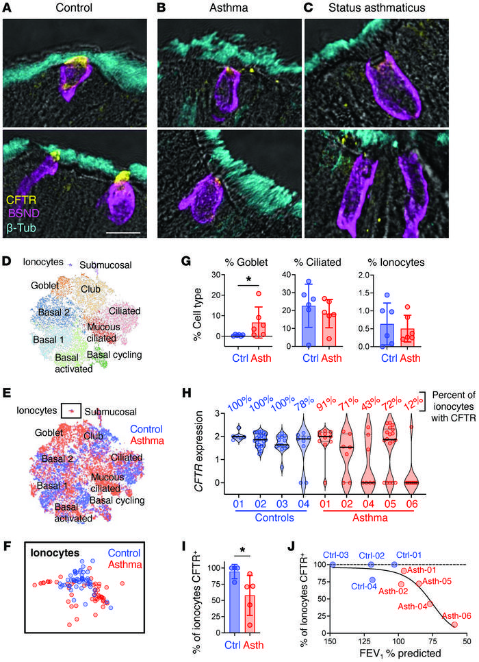 CFTR loss in ionocytes is associated with worsening airflow obstruction ...