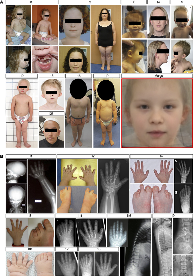 Clinical findings.
(A) Facial features of individuals with PTBP1 start-l...