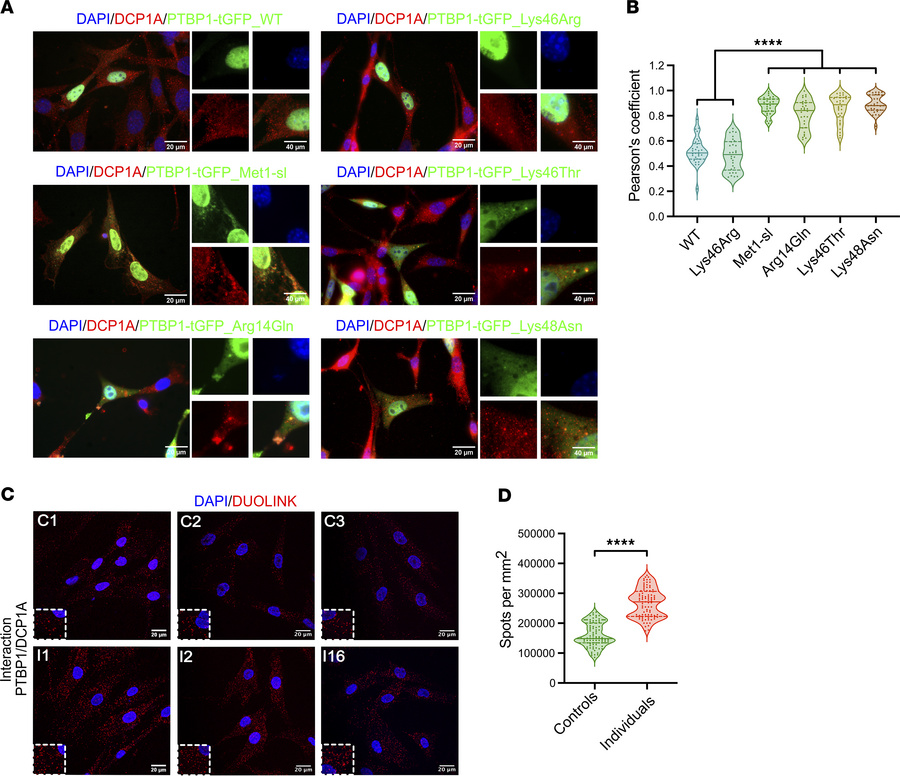 Cytoplasmic colocalization of start-loss PTBP1 variants with P-bodies.
(...