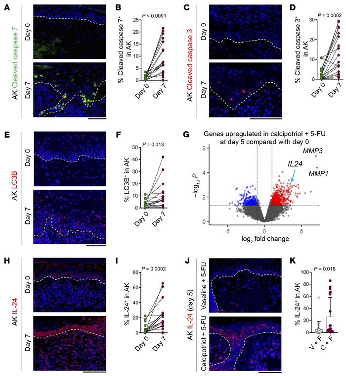 Calcipotriol-plus–5-FU treatment causes toxic autophagy and apoptosis as...