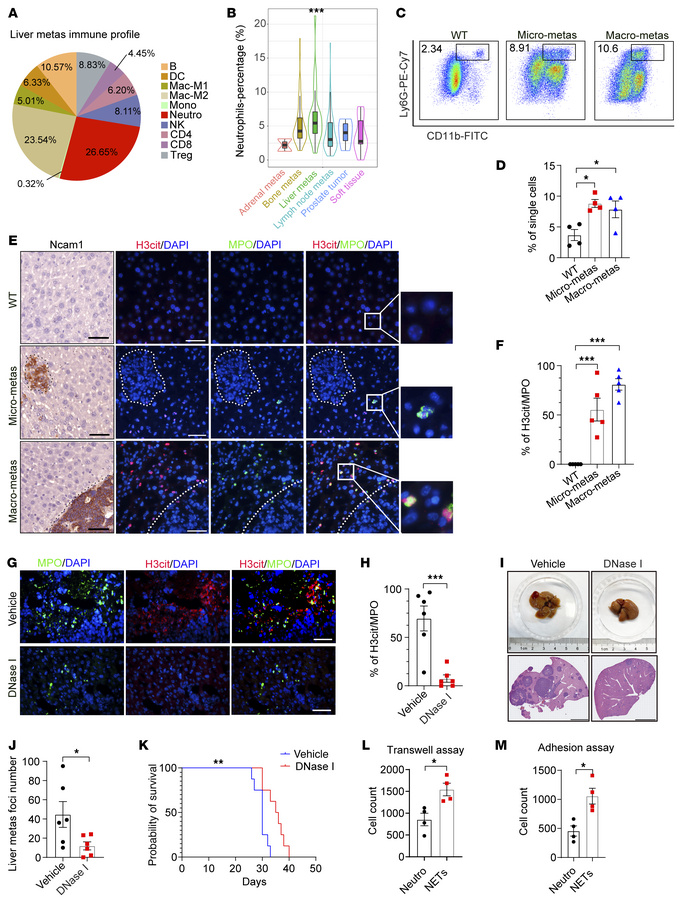 Neutrophil infiltration and NETs are detected in NEPC liver metastasis.
...