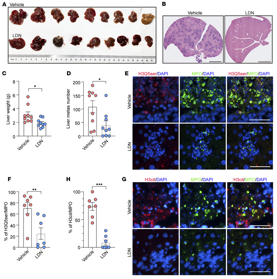 TGM2 inhibition abrogates NET formation and liver metastasis in NEPC mou...