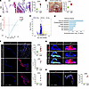 Fibrillin-1 deficiency associated with severe myxomatous mitral valve disea