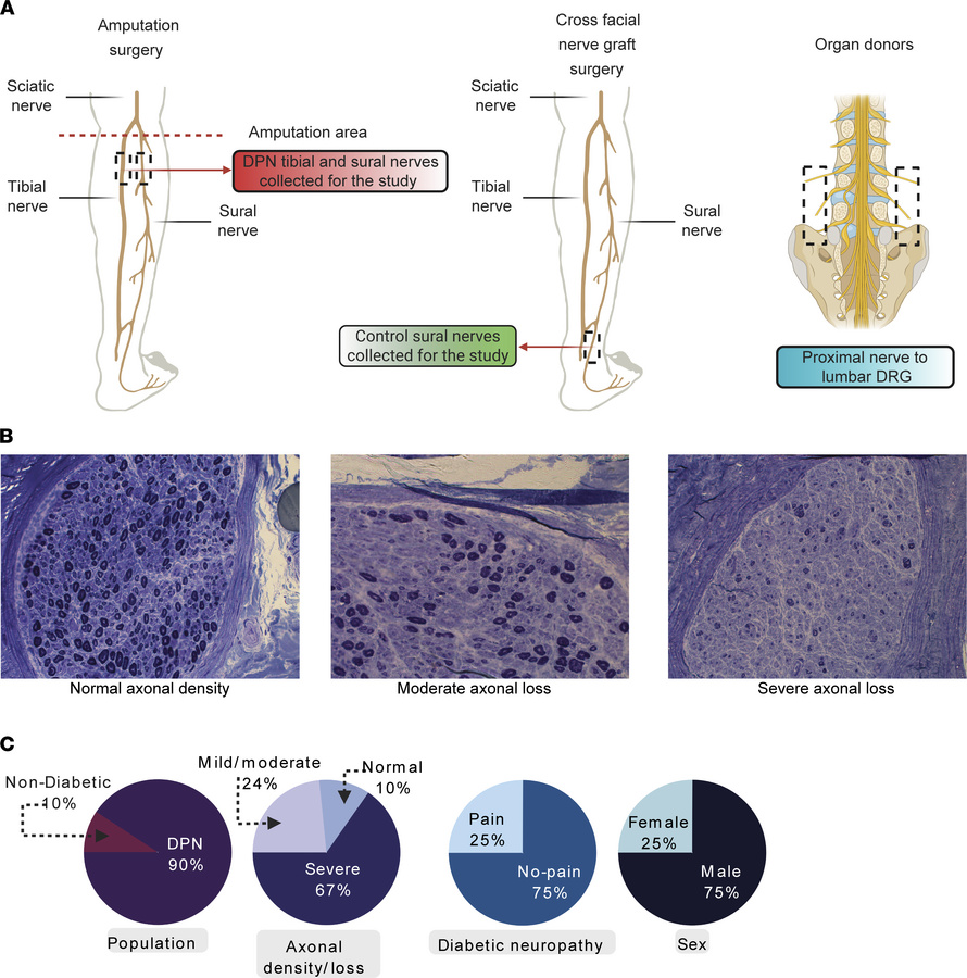 Nerve samples included in the study.
(A) Tibial and sural nerves were ha...
