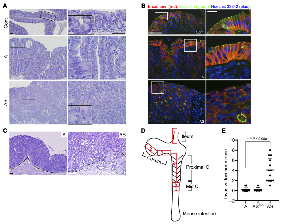 Mouse colon lesions with combined Apc and Sox9 inactivation had enhanced...