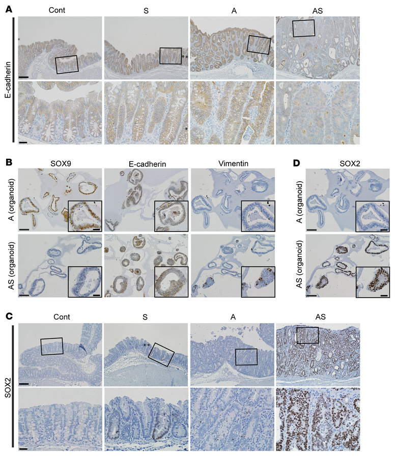 Reduced expression of E-cadherin and increased expression of SOX2 and vi...