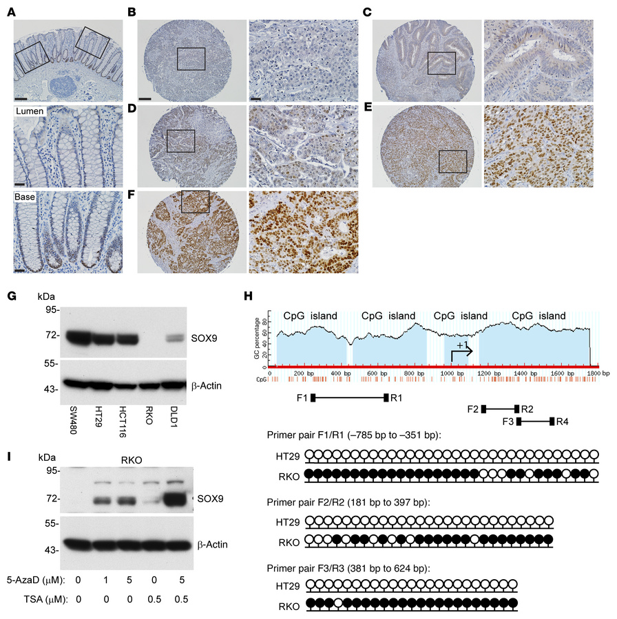 SOX9 protein expression and SOX9 gene methylation status in CRC primary ...