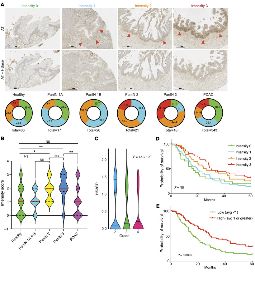 HSAT is expressed in early pancreatic intraepithelial neoplasia lesions ...