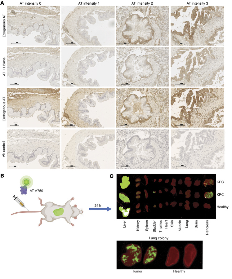 Exogenous and endogenous AT localizes to HSAT-positive tumor lesions.
(A...