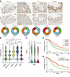 HSAT is expressed in early pancreatic intraepithelial neoplasia lesions lea