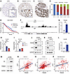 TRIM28 is an E2F1 target in advanced prostate cancer.