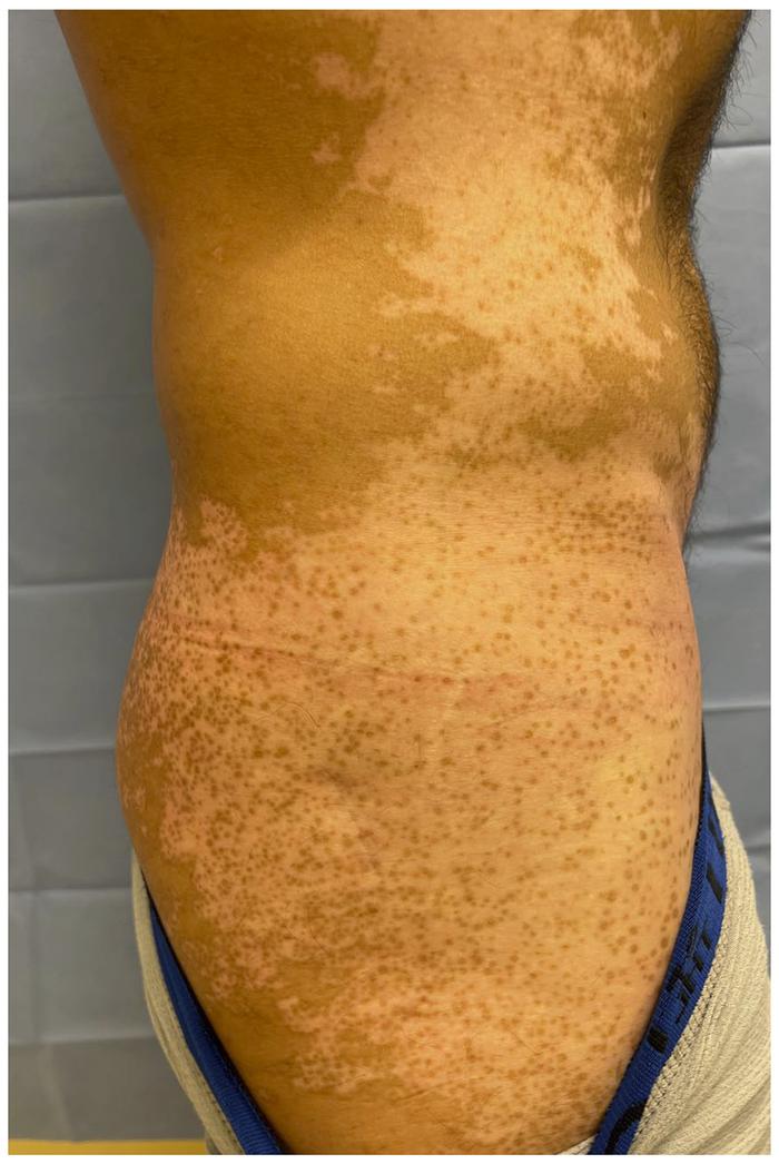Perifollicular repigmentation of a large area with vitiligo.
Pigmented s...