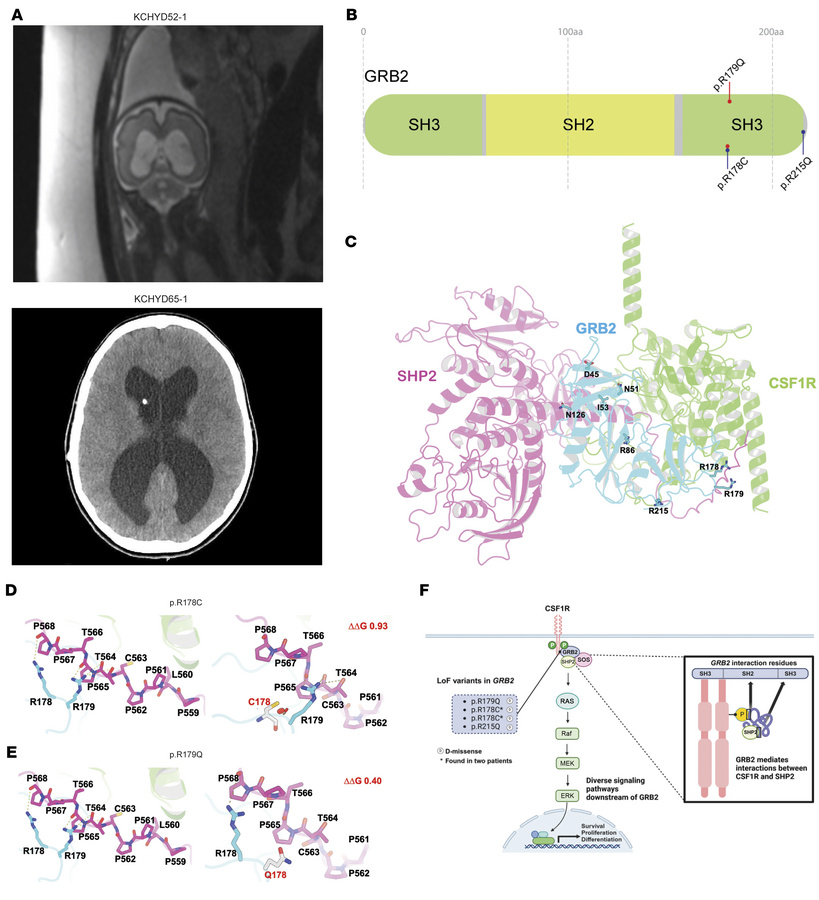 Recurrent, damaging variants in the GRB2 c-terminal SH3 domain in patien...