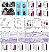 Epidermis-specific SPRY1-deficient mice spontaneously develop psoriasis-lik
