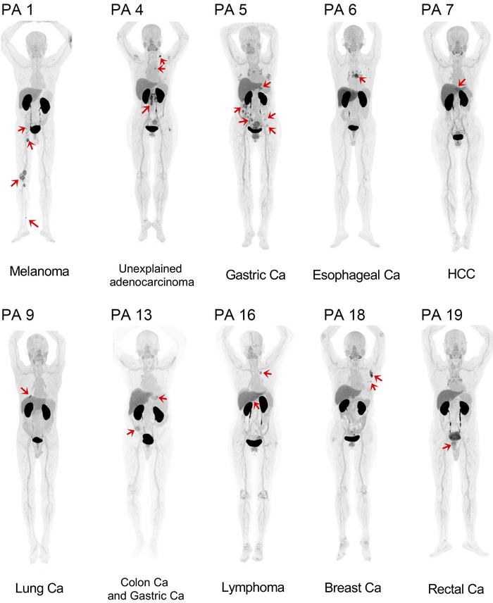 MIP images from [68Ga]Ga-B7H3-BCH PET scans of 10 different patients wit...