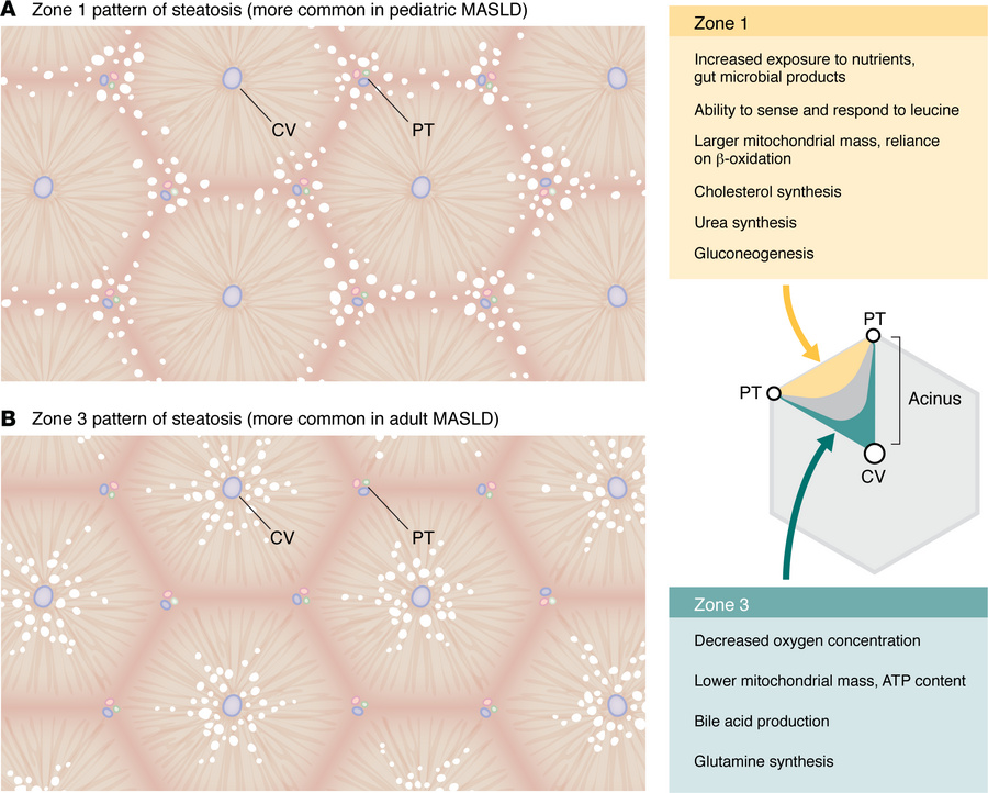 Patterns of steatosis distribution in pediatric MASLD.
Hepatocytes are s...