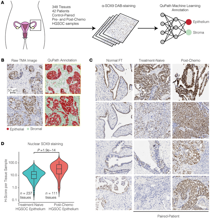 Tumor microarrays (TMAs) show nuclear SOX9 levels increase significantly...