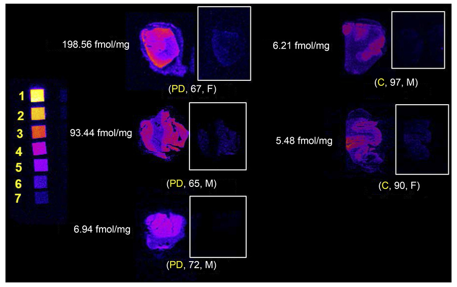 In vitro CSF1R autoradiography with [3H]JHU11761 in human inferior parie...