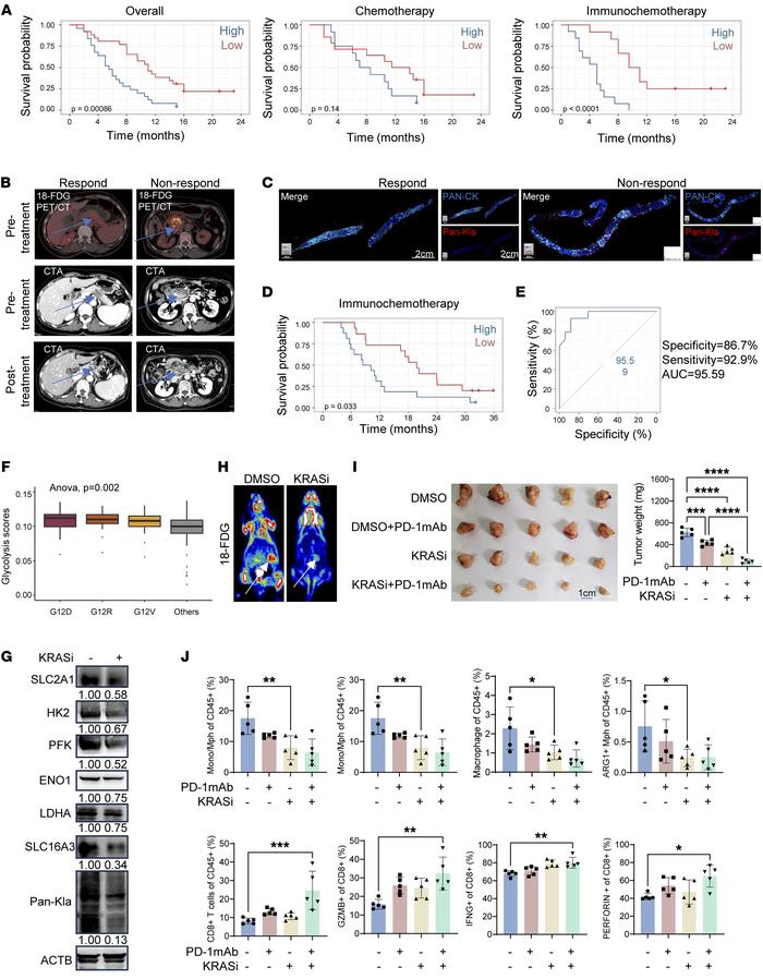 Elevated lactylation is associated with immunotherapy resistance in PDAC...