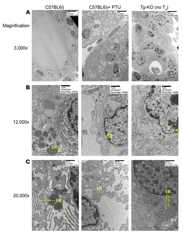 In the absence of TG expression, despite hypothyroidism, thyroid tissue ...