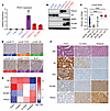 PROX1 is upregulated in patient-derived cell lines and xenografts exhibitin
