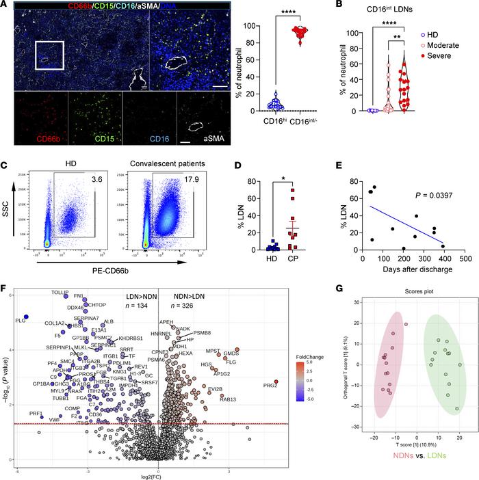 Neutrophilia and accumulated LDNs in COVID-19 patients.
(A) Massive infi...