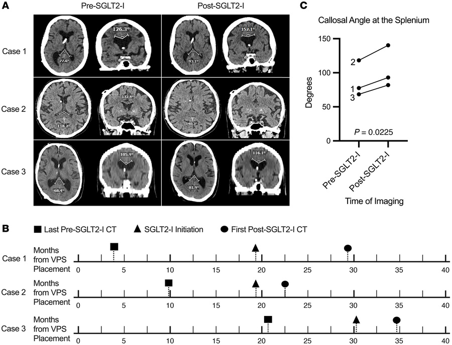 Effect of SGLT2 inhibition on ventricular size.
(A) Axial and coronal CT...