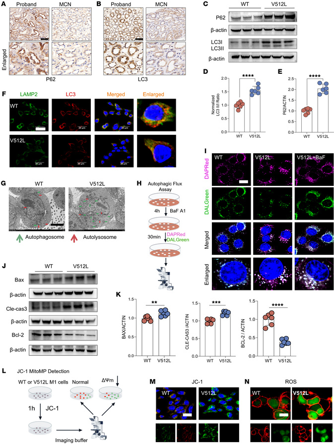 
ATP6V0A4 p.V512L mutation blocks autophagic flux and promotes apoptosis...