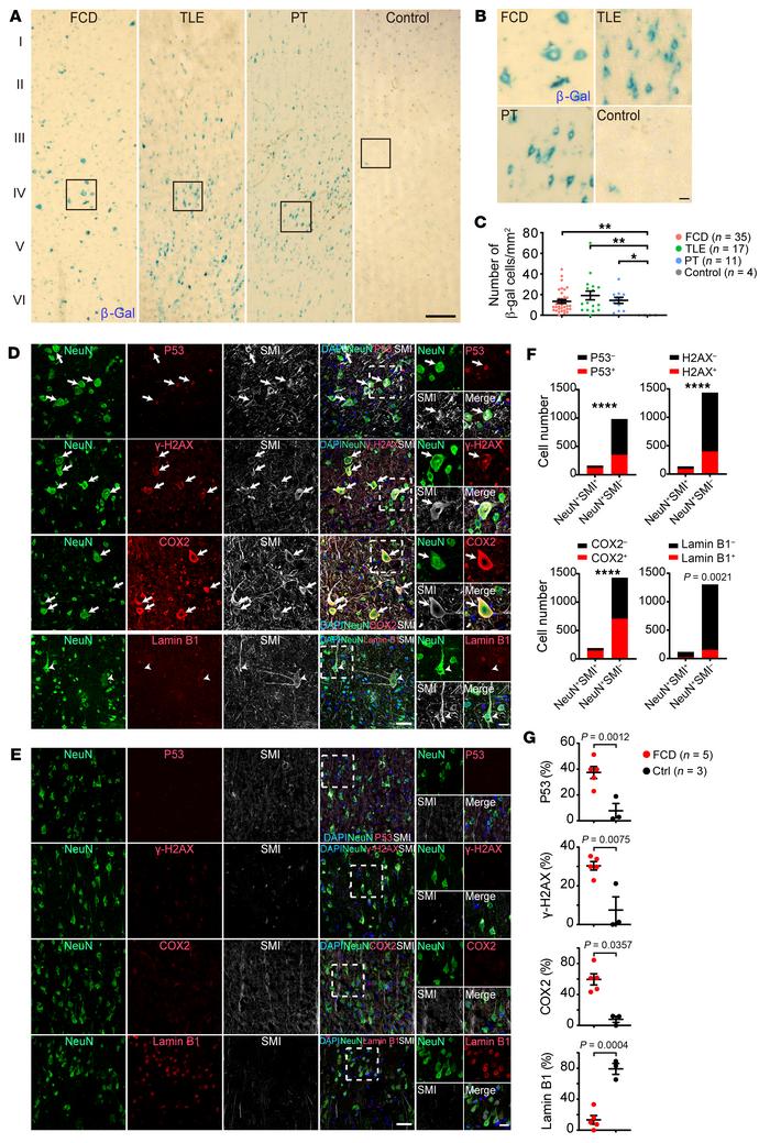Expression of senescent cell markers in histopathological neurons in peo...