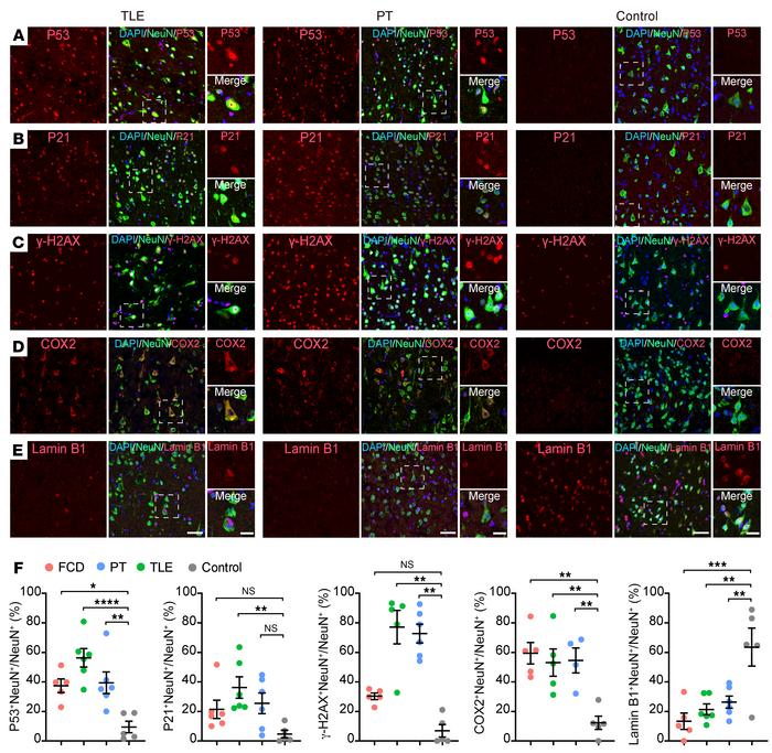 Expression of senescent markers in pathological neurons in the epileptic...
