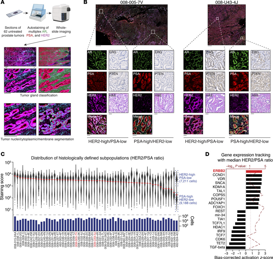 Human prostate tumors variably harbor distinct subpopulations of tumor c...