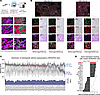 Human prostate tumors variably harbor distinct subpopulations of tumor cell