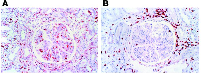 Immunohistochemical staining of a lupus renal biopsy. (A and
           ...